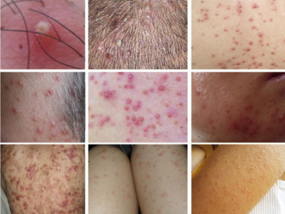 震惊！2019世界级最新发现！毛囊炎反复发作的“元凶”竟然是它！林雯轻满抑