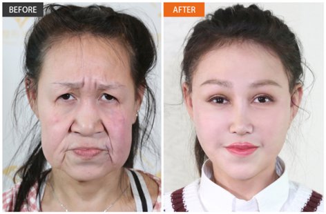 15岁少女 8小时手术换脸成功！