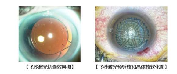 四川首台美国强生公司Catalys飞秒激光眼科治疗系统登陆成都爱迪眼科医院