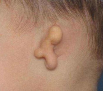 曾因耳畸形倍受议论，90后姐弟在广西爱思特完成耳再造后发生了哪些变化？