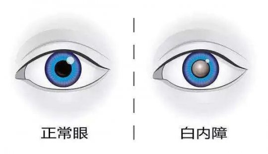 刘保松博士谈白内障⑤：警惕儿童致盲眼病--先天性白内障！